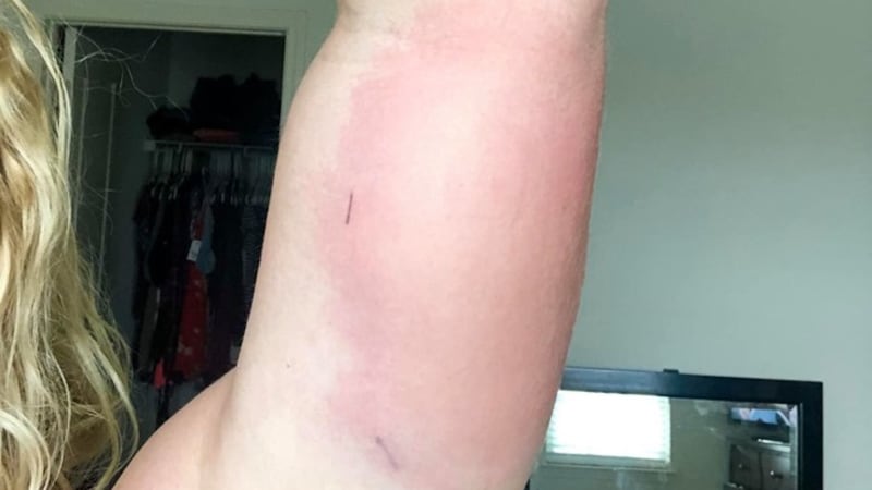 After an Indiana girl contracted a flesh-eating disease, a Walton County man says he...